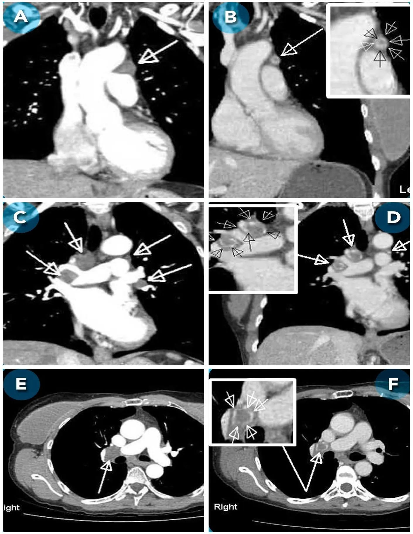 Tomografías de tórax de Alice B. con lesiones mediastinales y comparaciones posteriores al tratamiento.