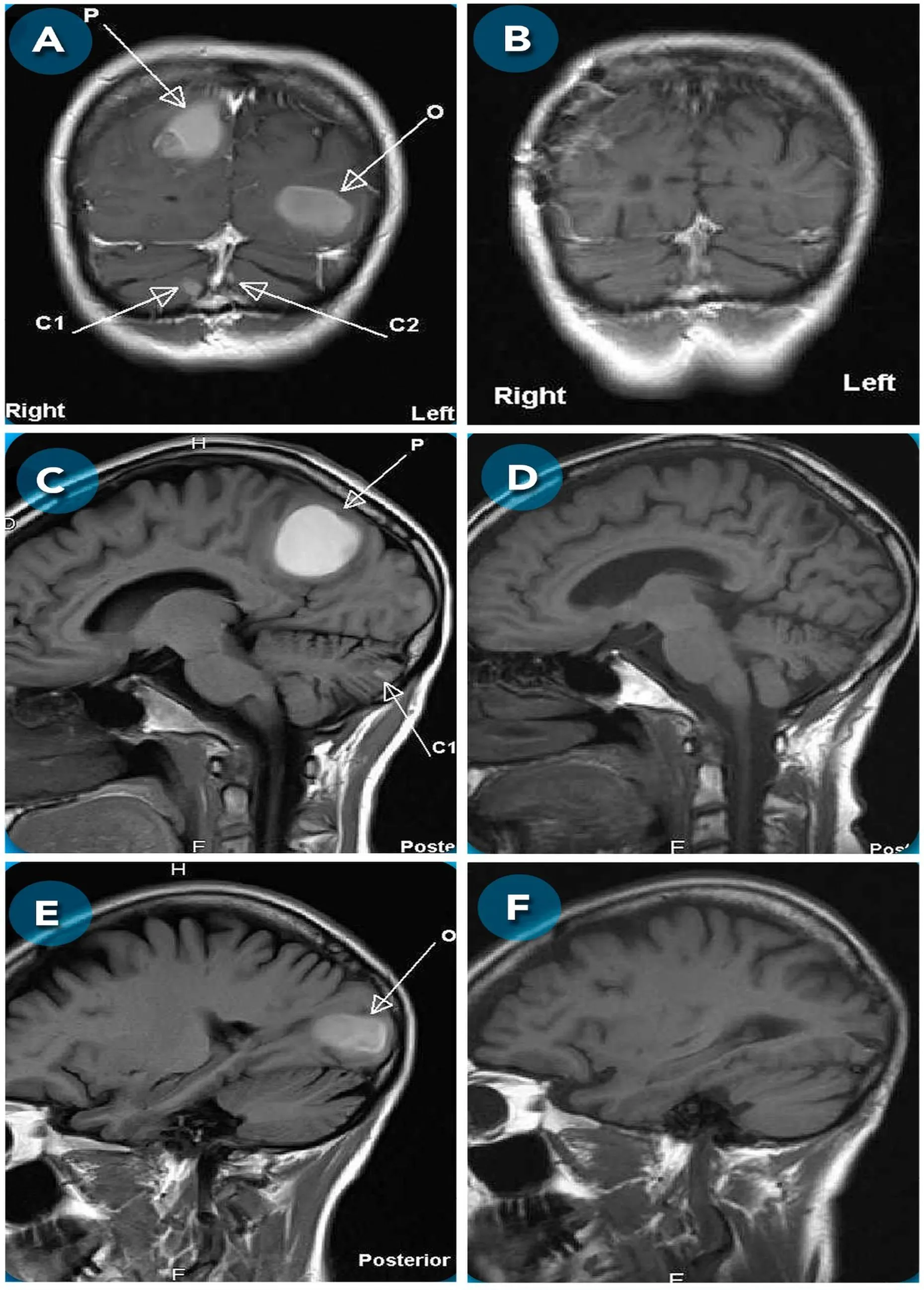 Secuencia de resonancias magnéticas de Barbara con lesiones metastásicas cerebrales identificadas con flechas.